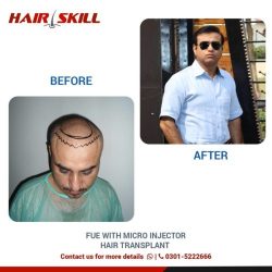 best hair transplant in Pakistan