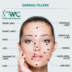 dermal-fillers1