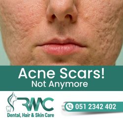 Laser Treatment For Acne Scars
