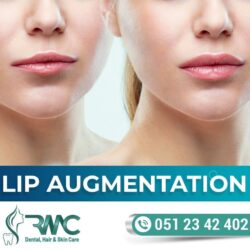 Lip Filler Treatment in Islamabad, Lip Fillers Injections In Islamabad- Lip Augmentation Treatment in Islamabad - Rehman Medical Center