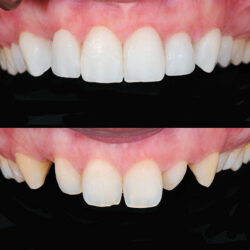Dental Implant Treatment in Karachi at HASH CLINICS