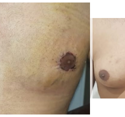 Gyno2